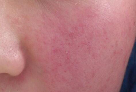 如何拯救你的敏感肌？廣西南寧美容培訓(xùn)叫你正確方法