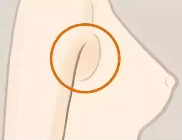 減副乳，瘦手臂一招就解決！