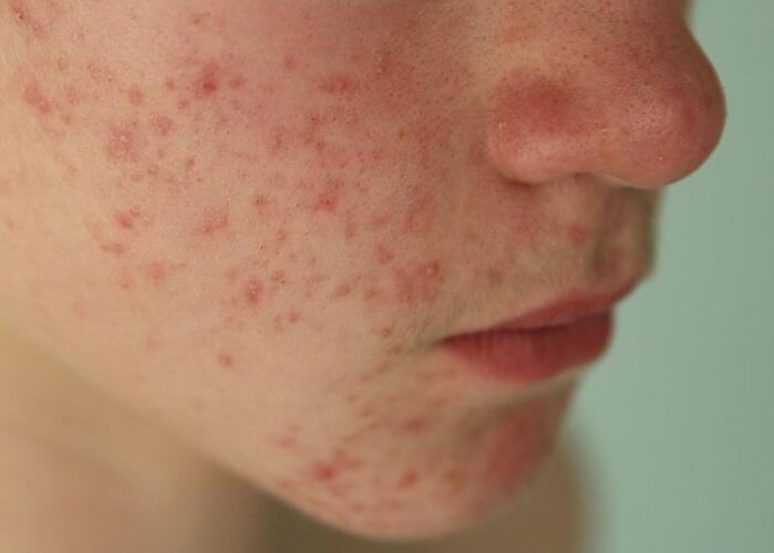 粉刺閉口應(yīng)該如何處理？