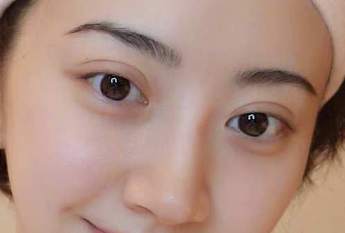 那些適合做雙眼皮手術(shù)的人群