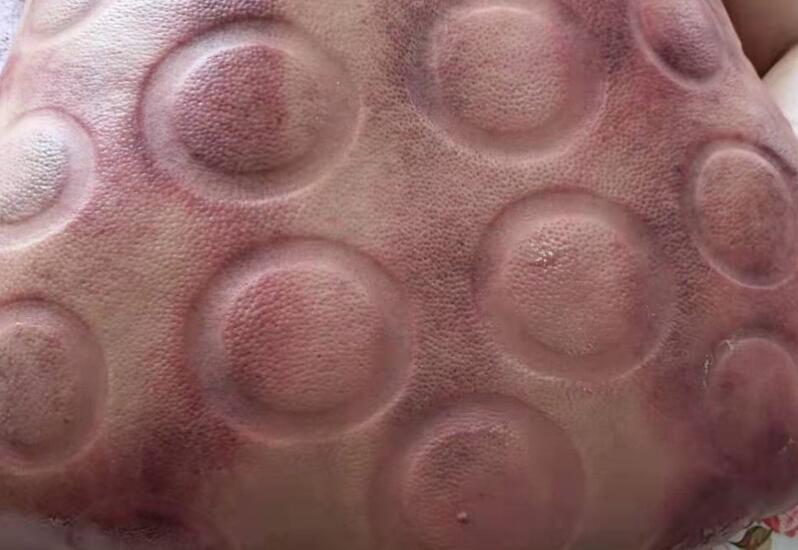 拔火罐有什么用？廣西美容職業(yè)培訓(xùn)學(xué)校演示給你看