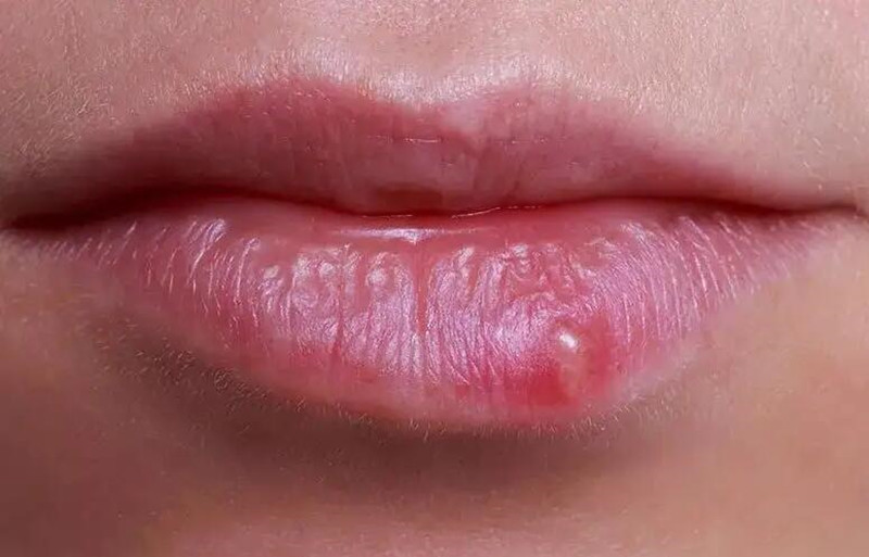 紋唇后起泡怎么辦？南寧紋唇培訓學校教你方法